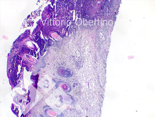 <p>Figure 9. Skin. Focal epithelial erosion in which the superficial layer is replaced by abundant amorphous to granular eosinophilic material with karyorrhectic debris (necrosis) and abundant degenerate, viable neutrophilic granulocytes. Multifocally, the epithelium appears moderately to markedly hyperplastic with moderate to severe orthokeratotic hyperkeratosis. Multifocal presence of crusting is also observed. The dermis appears diffuse and moderately fibrotic.</p>