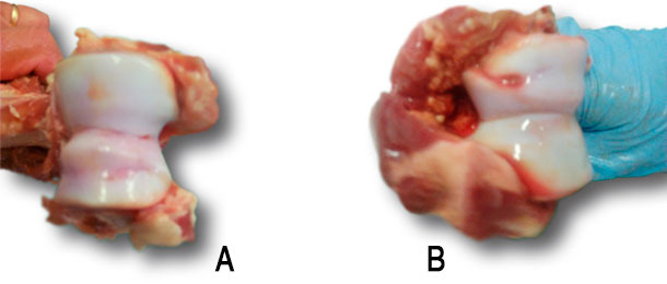 Osteochondrosis of the humeral condyle