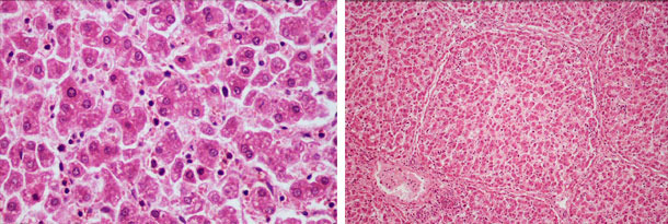 Diffuse hepatocyte ballooning degeneration and Diffuse hepatocyte disorganization