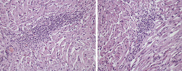 Myocarditis