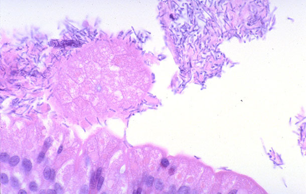 Small intestine of a piglet with diarrhea associated with Clostridium perfringens type A infection