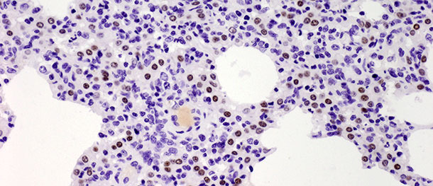  Brown dots indicate the nuclei of the Type II pneumocytes identified with anti-TTF-1 antibodies