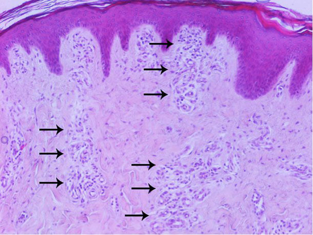 Histopathological examination of the skin: increased vascularization of the superficial and middle dermis mainly