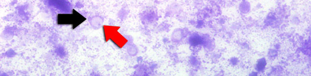 Fecal smear stained with Diff-Quick. Red arrow indicates the central vacuole. Black arrow indicates the nucleus