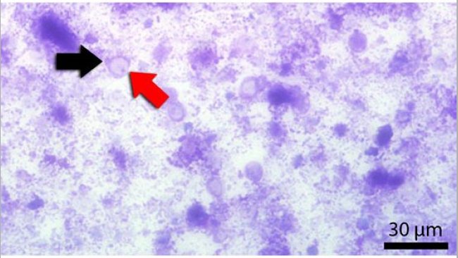 Fecal smear stained with Diff-Quick. Red arrow indicates the central vacuole. Black arrow indicates the nucleus