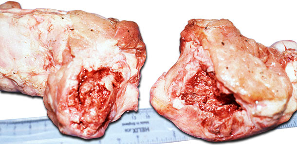 Entire head of the femur fractured at or below the epiphysis showing swelling around fracture site due to periostitis