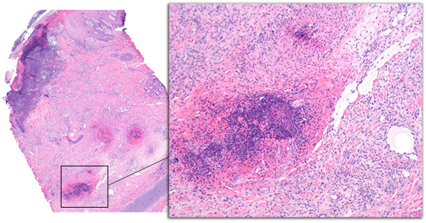 Ear tip biopsy from a chronically affected pig.  Epidermal changes include ulceration with subjacent inflammation, serocellular crust formation, and acanthosis of the epidermis.  The deep dermis is expanded by granulation tissue and hemorrhage.Deep dermal vessels are disrupted by thrombosis and vasculitis