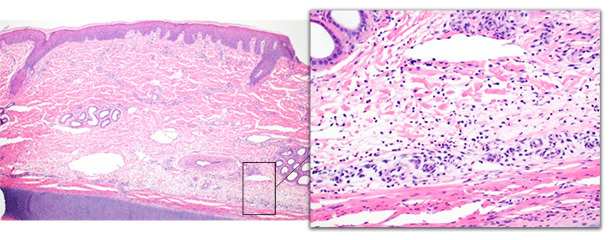 Ear tip biopsy from an acutely affected pig.  The deep dermis is expanded by edema and moderate numbers of neutrophils with minimal epidermal changes. 