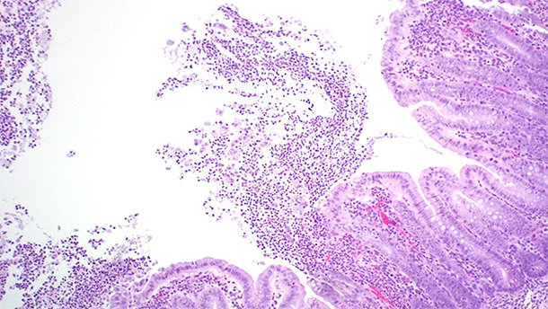 Histopathologic examination of affected animals revealed a multifocal to locally extensive ulcerative fibrinopurulent colitis