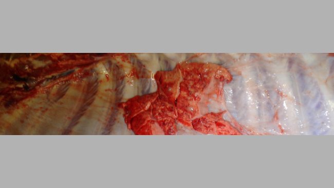 Pleurisy in lungs 1