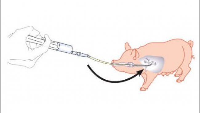 Sketch showing a bronchoalveolar lavage and bronchial scraping