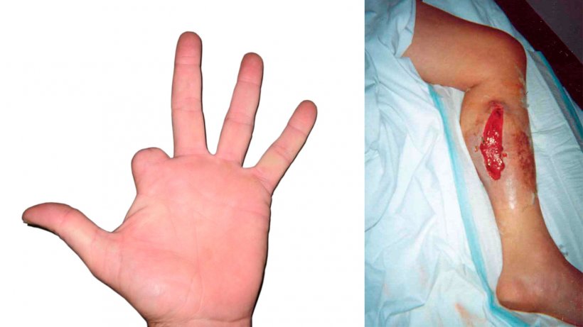 Picture 2: This producer accidently injected his finger with a vaccine containing an oil adjuvant.&nbsp; He did not seek immediate care for this, and the finger had to be amputated as the blood and nerve supply had been cut off by the inflammation.

Picture 3: Accidental vaccine injection. The leg had to be operated on to remove the damaged tissue, and flush out the vaccine and adjuvant.
