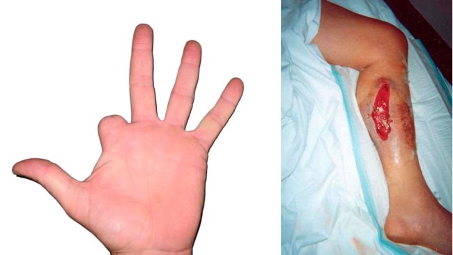 Picture 2: This producer accidently injected his finger with a vaccine containing an oil adjuvant.  He did not seek immediate care for this, and the finger had to be amputated as the blood and nerve supply had been cut off by the inflammation.
Picture 3: Accidental vaccine injection. The leg had to be operated on to remove the damaged tissue, and flush out the vaccine and adjuvant.