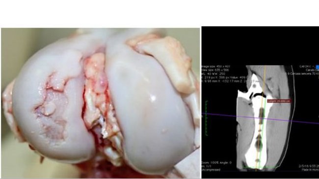 Macroscopic view of a knee joint with a severe osteochondrosis lesion in the lateral femoral condyle.
