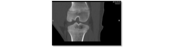 Computerised tomography view of the same lesion. Severe osteochondrosis lesion with lack of ossification in the subarticular region of the lateral femoral condyle.
