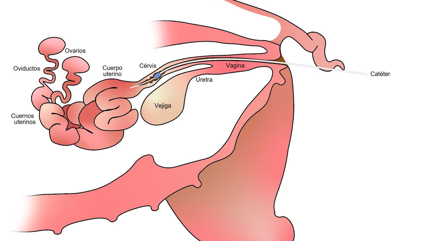 Figure 1. With post-cervical insemination the semen is deposited in&nbsp;the uterine body, past the cervix.
