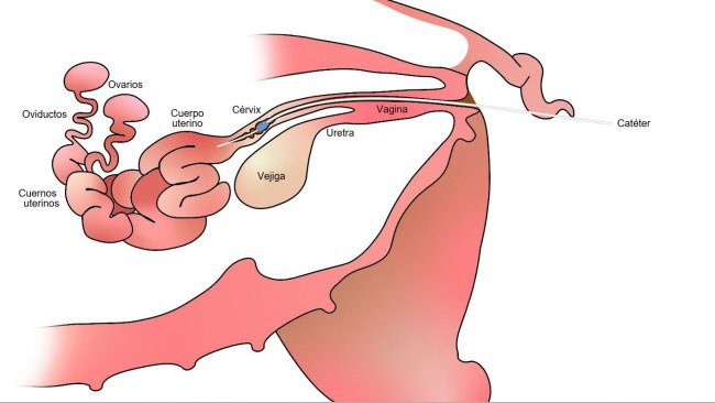Figure 1. With post-cervical insemination the semen is deposited in&nbsp;the uterine body, past the cervix.
