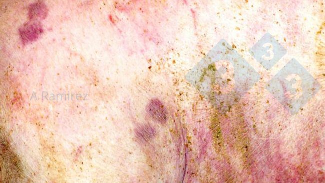 Figure 1. Almost pathognomonic diamond-shaped skin lesion.