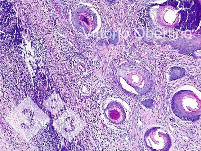 Figure 8. Navel. Locally widespread dermal area consisting of fibroplasia with activated fibroblasts and numerous immature small vessels (newly formed granulation tissue), multifocal inflammatory infiltrate with predominance of lymphoplasmacellular cells; in some vascular structures there is a granulocytic inflammatory infiltrate surrounding the vessel wall and focally infiltrating it (leukocytoclastic vasculitis).
