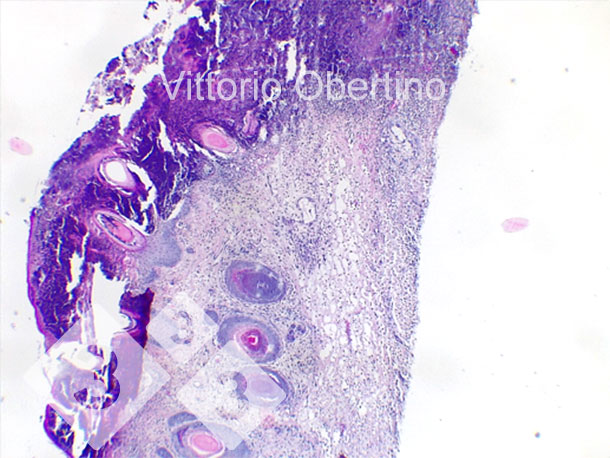 Figure 9. Skin. Focal epithelial erosion in which the superficial layer is replaced by abundant amorphous to granular eosinophilic material with karyorrhectic debris (necrosis) and abundant degenerate, viable neutrophilic granulocytes. Multifocally, the epithelium appears moderately to markedly hyperplastic with moderate to severe orthokeratotic hyperkeratosis. Multifocal presence of crusting is also observed. The dermis appears diffuse and moderately fibrotic.
