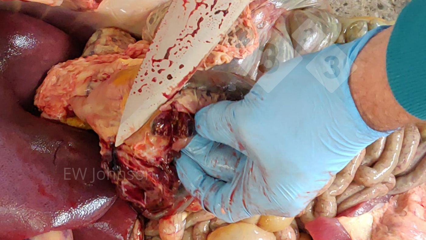 Photo 2. Hemorrhage and necrosis in gastrohepatic lymph node.
