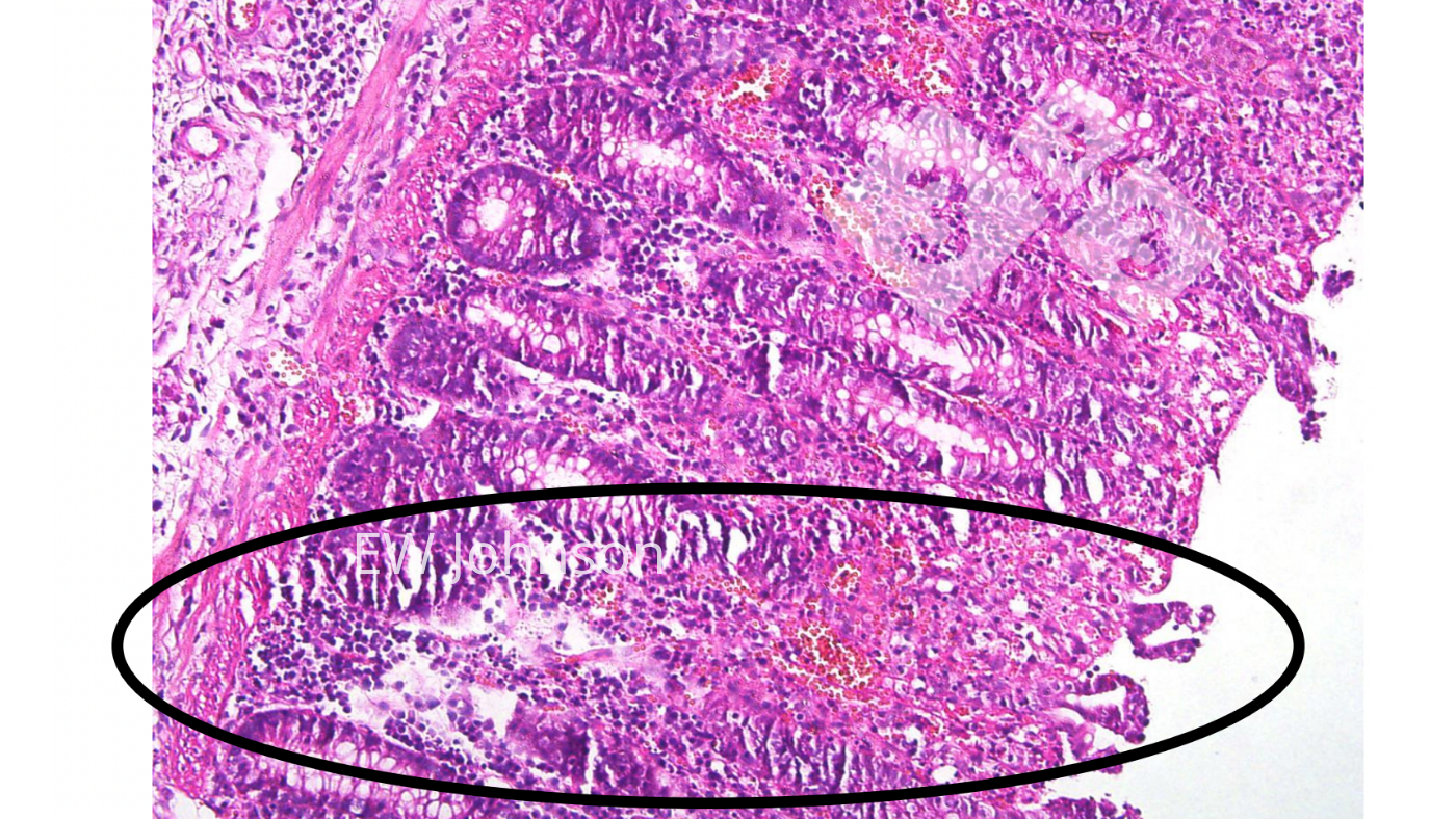 Vascular thrombosis, infarction, ulceration in colonic mucosa