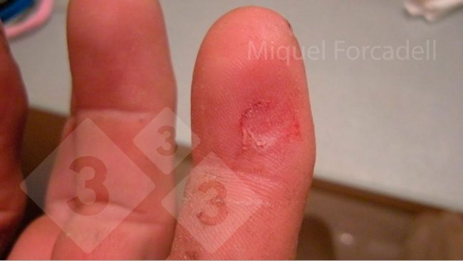 The small, sharp teeth of the piglets can cause these bothersome injuries to the workers' fingers during tooth grinding.