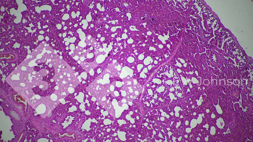 Figure 3.&nbsp;Interstitial pneumonia suggests a possible viral causation
