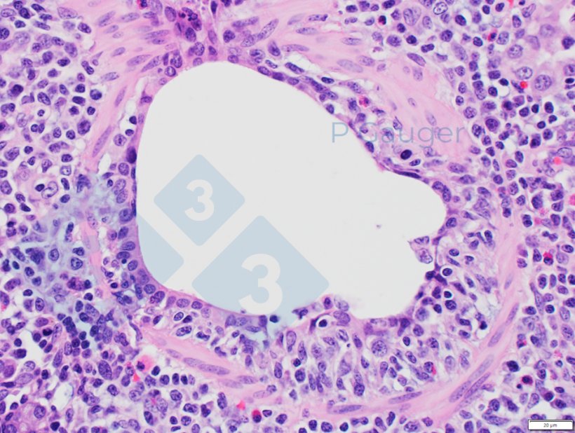 Figure 3: Lung histopathology showing thinning of the bronchiolar epithelium, which is an example of necrotizing (photo source: Phil Gauger ISUVDL)