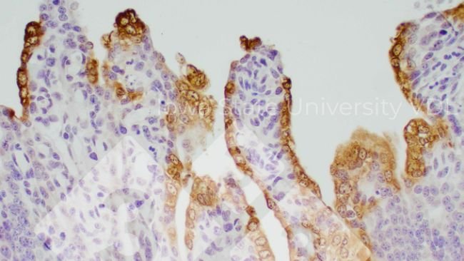 Figure 1. PED IHC staining of infected small intestine. Source: Iowa State University VDL.