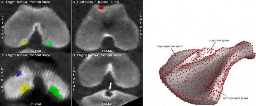 Figure 5. Right: Frontal and lateral views of femoral heads with lesions on the articular surface. Left: Three-dimensional image of the scapula.
