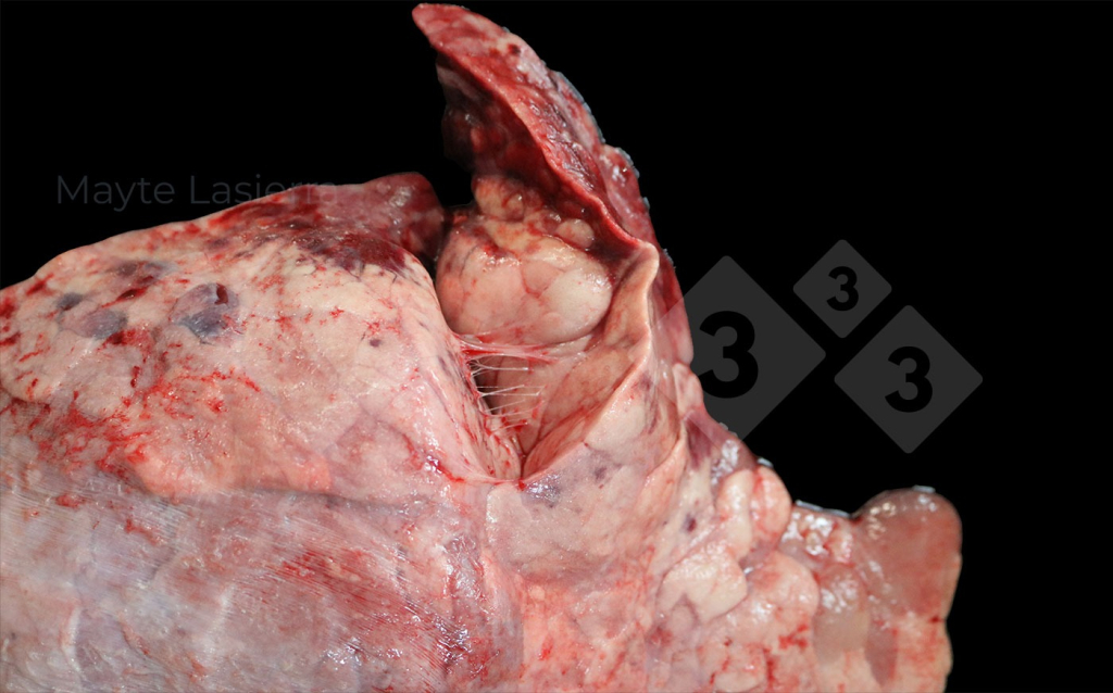 <p>Cranial pleuritis</p>
