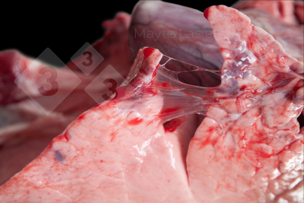 <p>Cranial pleuritis</p>
