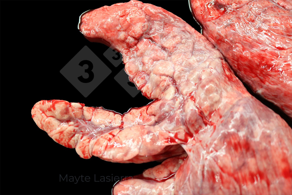 <p>Scarring</p>

