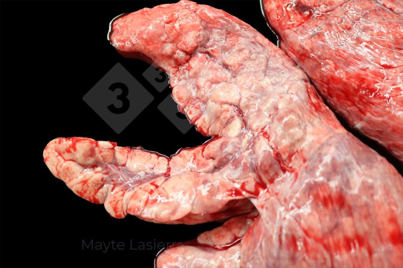 Scarring
