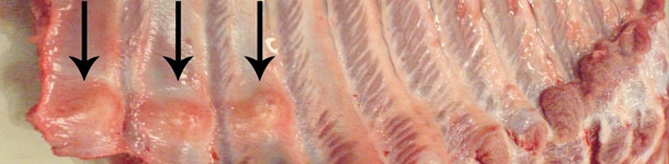 Multiple distal rib fractures with callus formation (arrows).