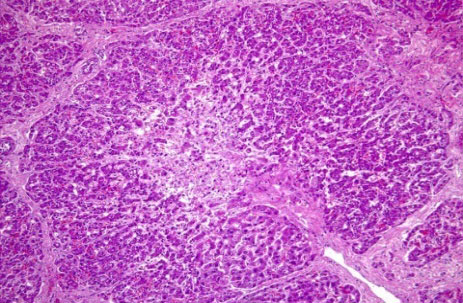 Centrilobular necrosis of the hepatocyte and a massive destruction of the liver structure with mononuclear inflammation and megalocytes