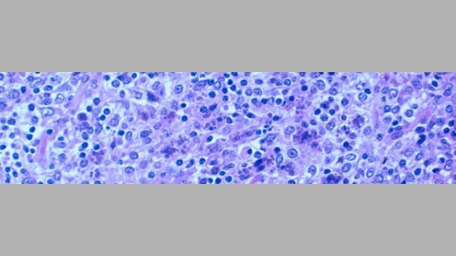 Severe lymphocyte depletion with granulomatous inflammation of lymphoid tissues. Presence of intracytoplasmic inclusion bodies
