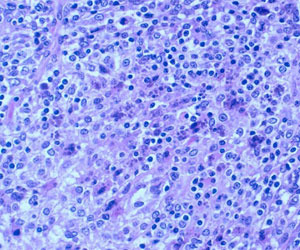 Severe lymphocyte depletion with granulomatous inflammation of lymphoid tissues. Presence of intracytoplasmic inclusion bodies