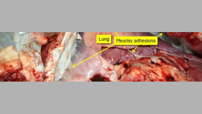 Pericarditis