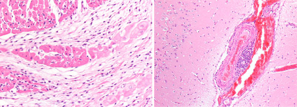 Congestion of the right cerebral hemisphere veins. Myocardium, right ventricle, myocardial basophilic focal necrosis with microvacuolization of the conduction system.