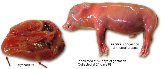 Myocarditis and ascites