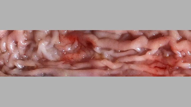 Thickening of the intestinal mucosa in the distal area of the small intestine