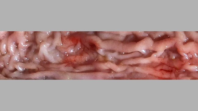 Thickening of the intestinal mucosa in the distal area of the small intestine