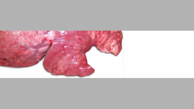 Pneumonia
