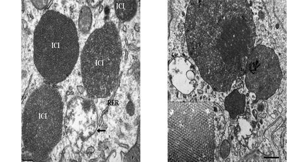 Electron micrograph of a lymph node from a PCV2-SD affected pig. Note the presence of PCV2 intracytoplasmic inclusion bodies (ICI); in some areas, the viral particles can be arranged in paracristalline arrays (inset of the right image).