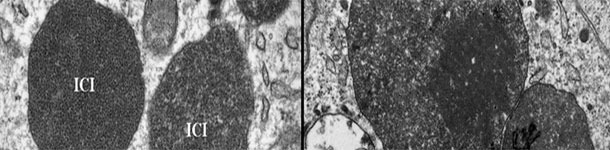 Electron micrograph of a lymph node from a PCV2-SD affected pig