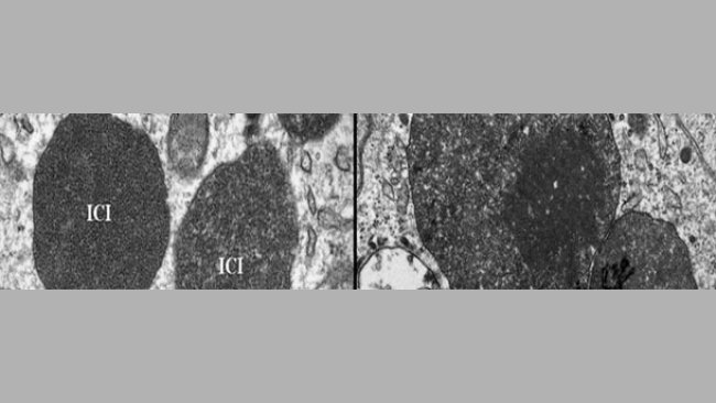 Electron micrograph of a lymph node from a PCV2-SD affected pig