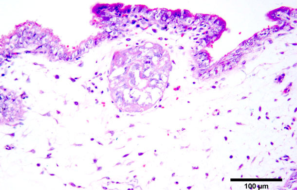 Coagulation necrosis of trophoblasts. Haematoxylin and eosin stain. 