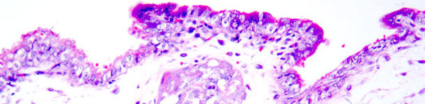 Coagulation necrosis of trophoblasts. Haematoxylin and eosin stain. 